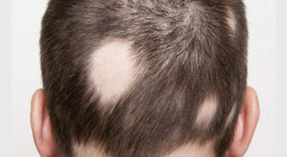 alopecia-areata-treatment