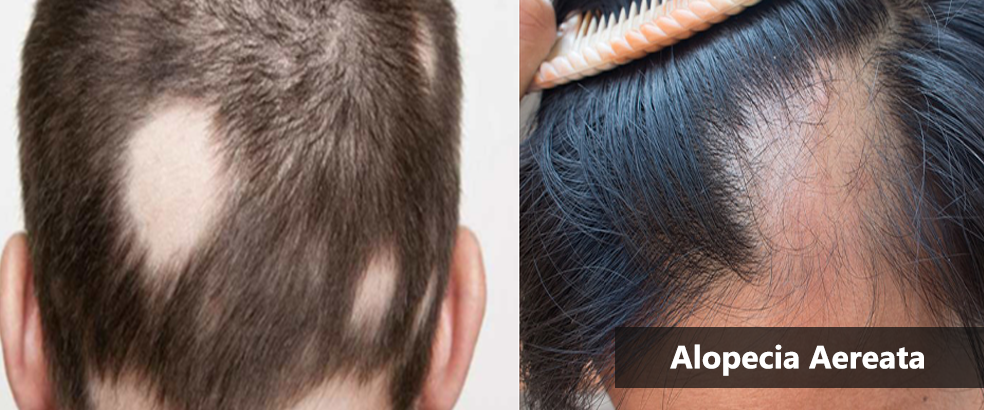 alopecia-areata