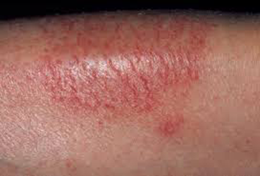eczeme-type-asteatotic