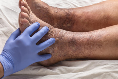 eczeme-type-varicose