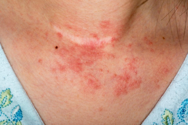 eczeme-type-atopic