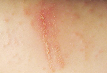 eczeme-type-contact-dermatitis
