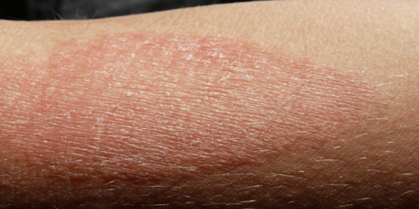 eczema-symptoms